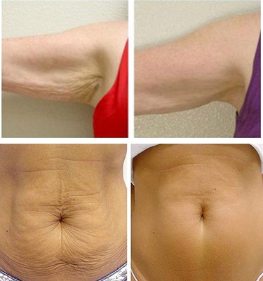 Benefits of Post Bariatric Surgery
