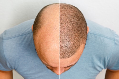 Hair transplantation In Mumbai