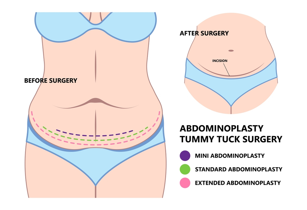 Types of Tummy Tuck/Abdominoplasty in mumbai