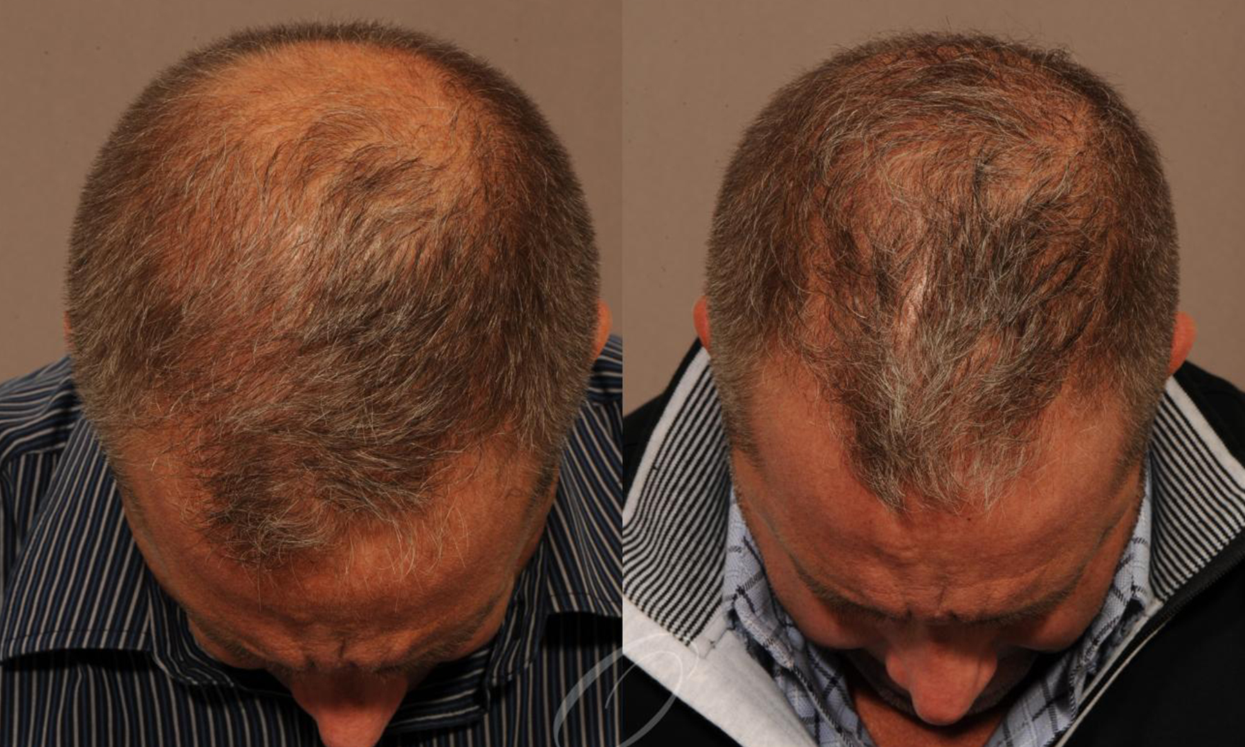 hair transplant