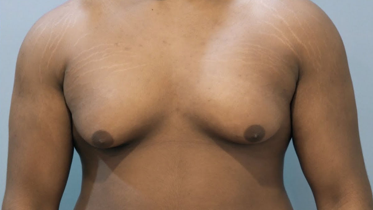 Ideal Candidates for Gynecomastia Surgery