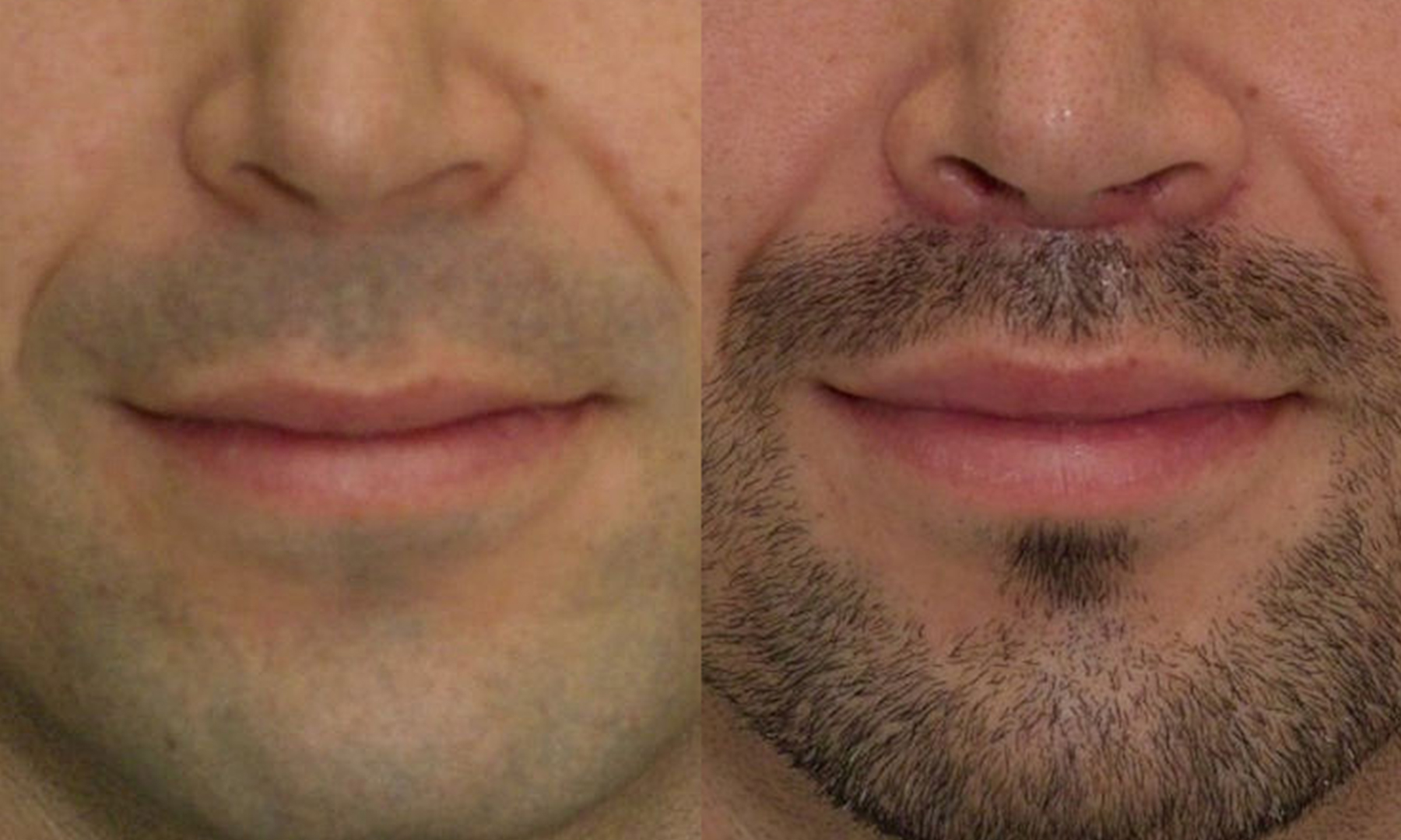 lip augmentation male