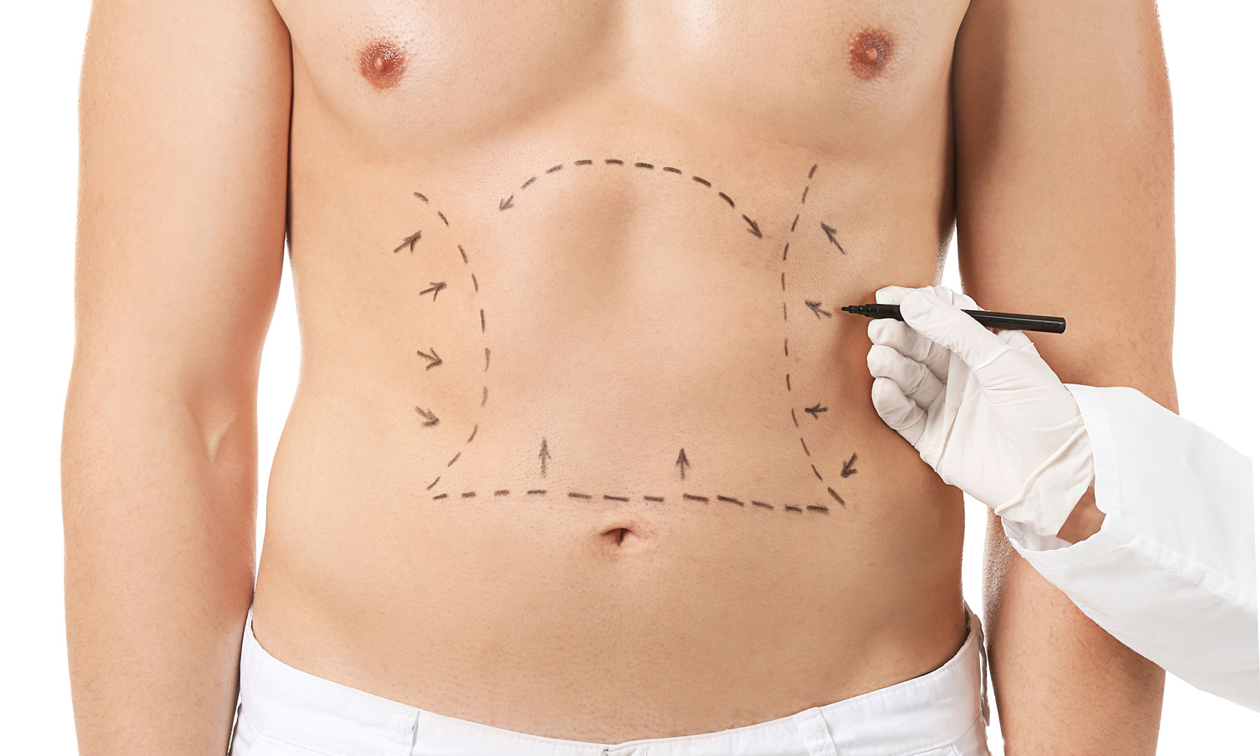 liposuction male