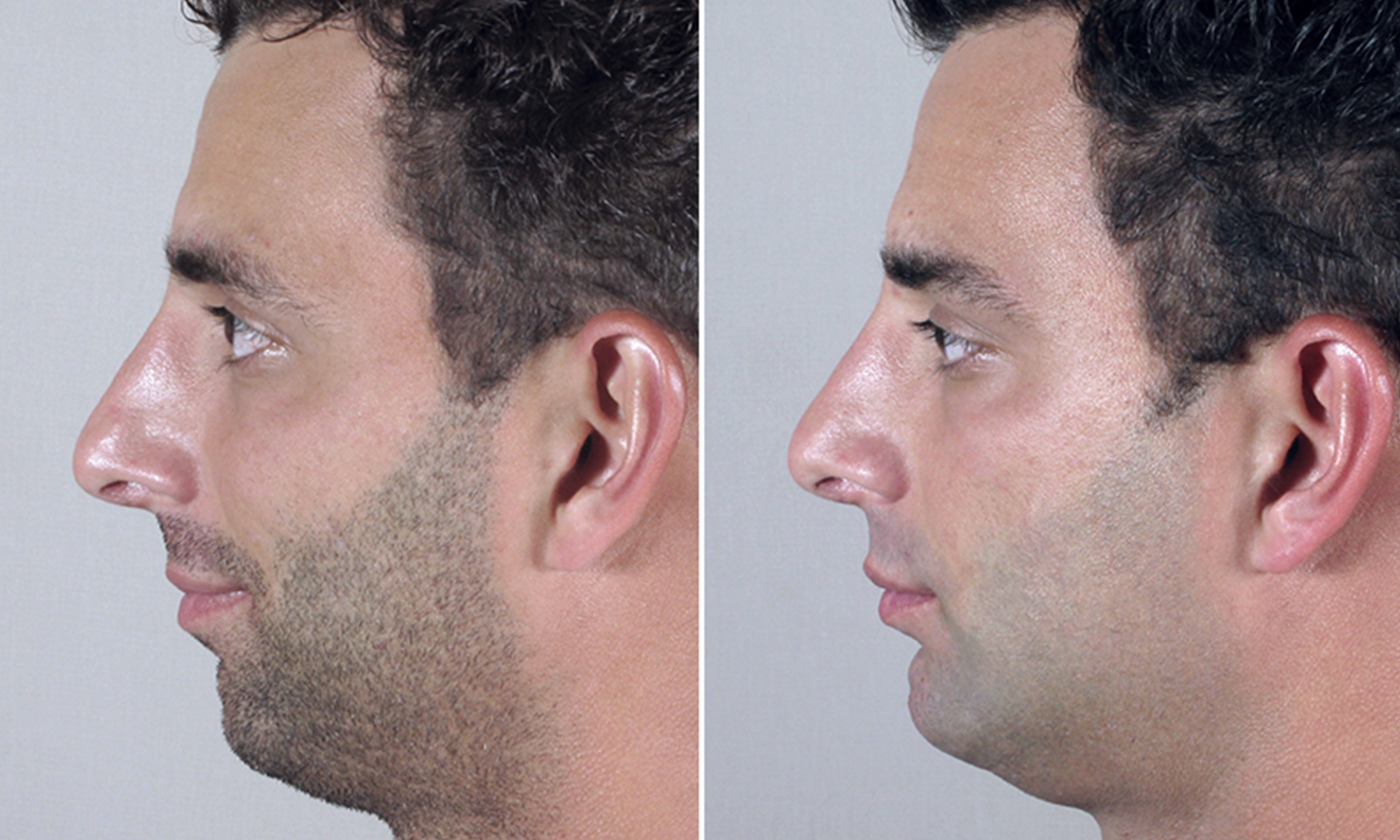 male rhinoplasty