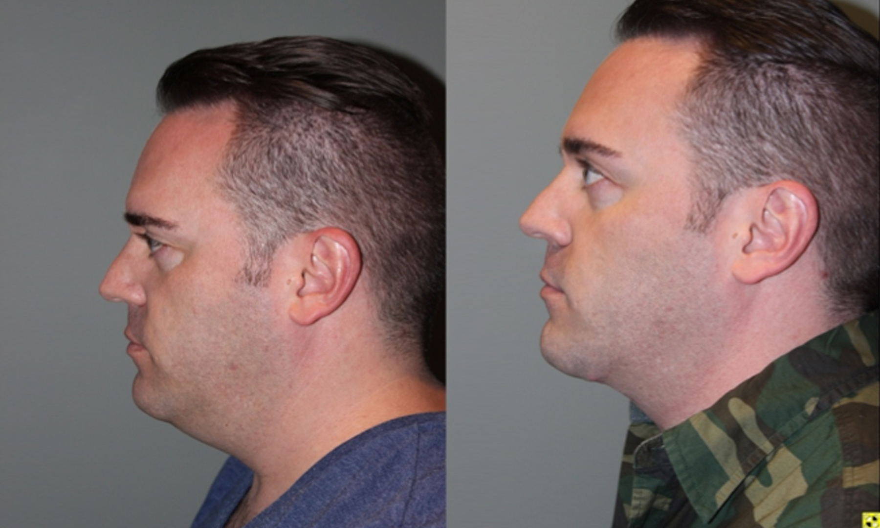 neck lift male