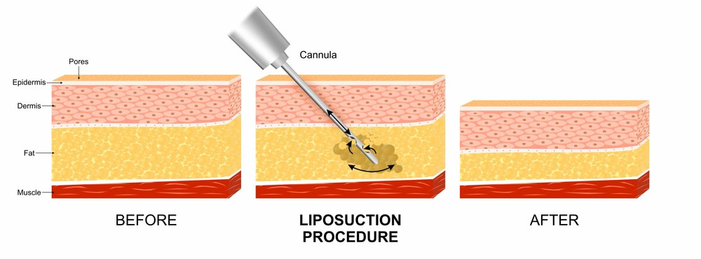 procedure