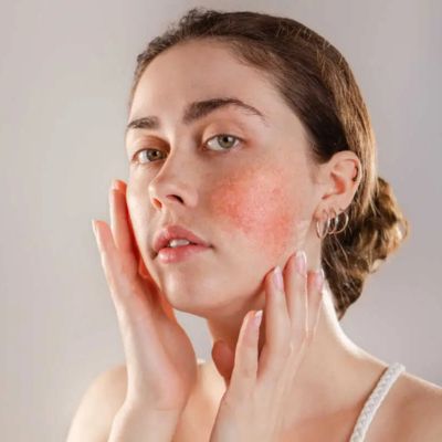Dermatological Procedures