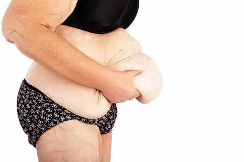 Post Bariatric Surgery in Mumbai